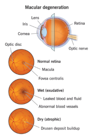 Macular Degeneration